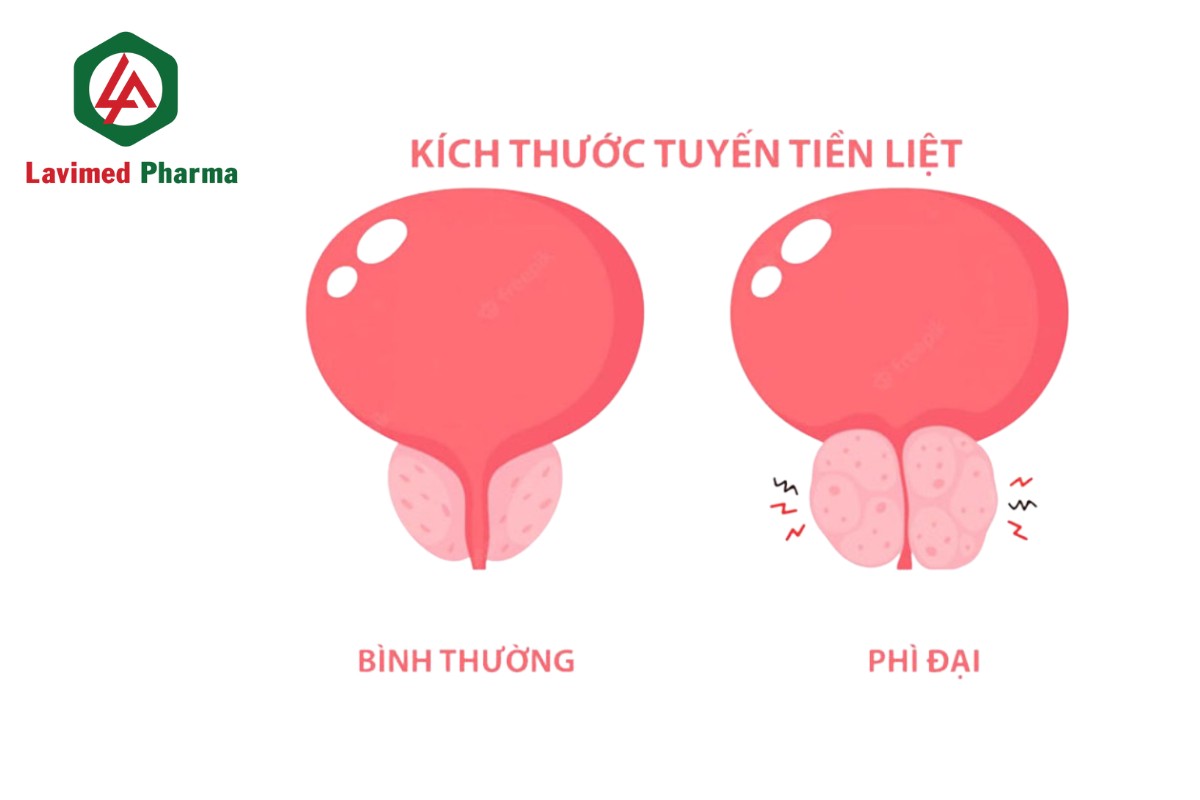 Phì đại tuyến tiền liệt