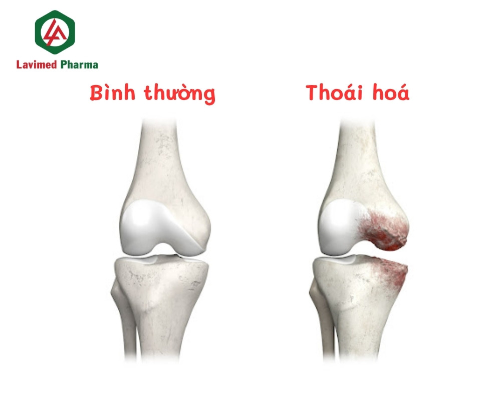 So sánh khớp bình thường và đã bị thoái hoá