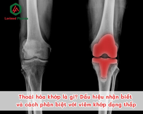 Thoái hóa khớp là gì? Dấu hiệu nhận biết và cách phân biệt với viêm khớp dạng thấp